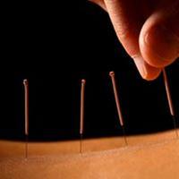 James J Frisa LAC Acupuncture Image
